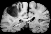 Lobar hemorrhage secondary to rupture of mycotic aneurysm